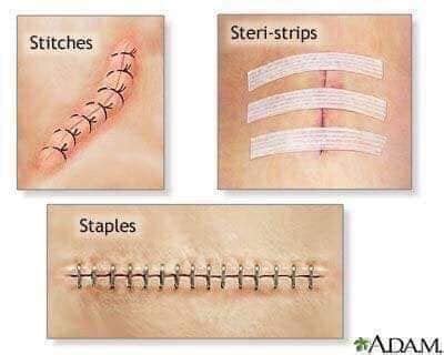 Different Types of Stitches for Surgical Nursing