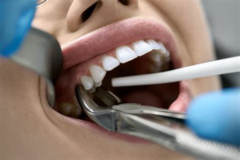 Tooth Extraction: When Will Dentists Pull Teeth? - Dr. Varley