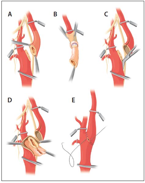 Carotid Endarterectomy: The Eversion Technique - Endovascular Today