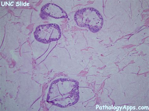 mucinous adenocarcinoma pathology