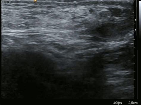 Inguinal Hernia - Classification - Management - TeachMeSurgery