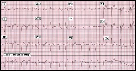 ECG Interpretation: ECG Interpretation Review #31 (A Fib – RBBB – LBBB ...