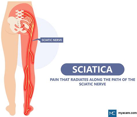 SCIATICA AND LEG WEAKNESS: A WORRYING COMBO | Mya Care