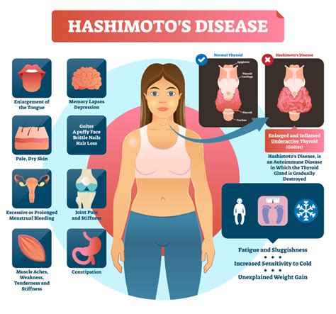 HASHIMOTO'S DISEASE & SSD BENEFITS