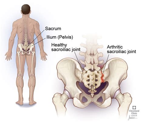 What is a Sacroiliac Joint Injection? - Integrative Pain & Spine Institute