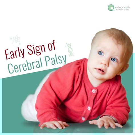 Early signs of Cerebral Palsy | Cerebral palsy baby, Signs of cerebral ...