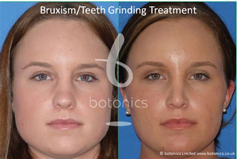 Bruxism Grinding Clenching Treatment with Botox - botonics