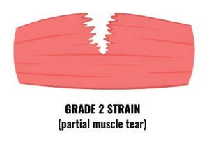 Calf Strain Diagnosis - Calf Strain Symptoms & Diagnosis