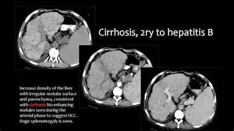 Pet Scan Results Lymphoma - Pet Spares