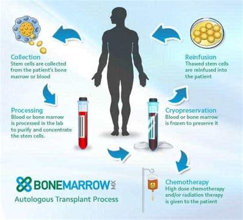 Autologous Stem Cell Transplantation | UAMS Stem Cell Transplantation ...