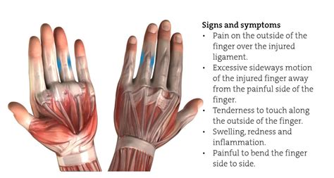 Collateral Ligament Sprain – The Climbing Doctor