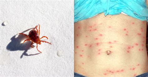 Chigger Bite Pictures: Symptoms, Prevention, and Treatment | Marham