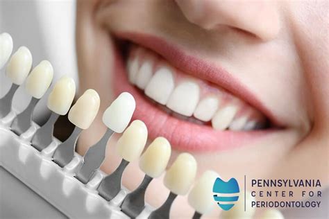 Is teeth whitening safe for my gums? | PA Center For Periodontology