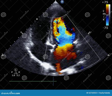 Doppler echocardiography stock image. Image of atrium - 52734353