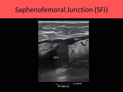 Ultrasound Registry Review - Extremity Venous Vascular Ultrasound ...