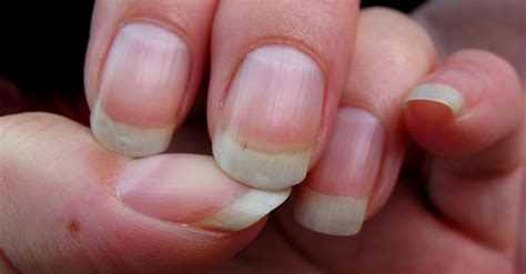 Diseases and Medical Disorders That Show Up In Your Nails First | Dusty ...