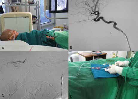 Intra-arterial chemotherapy: Procedure in the Cath lab (A) Patient ...