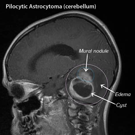 Pathology Glossary: Pilocytic Astrocytoma | Draw It to Know It