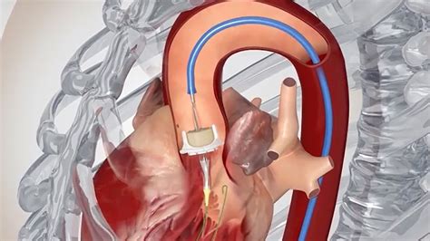 Transcatheter Aortic Valve Replacement (TAVR) | School of Medicine ...