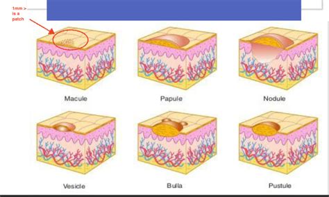 Macule Vs Papule