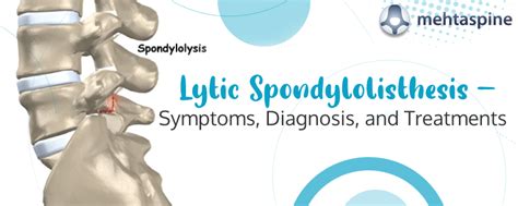 Diagnosis and Treatment of Lytic Spondylolisthesis