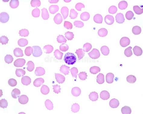 Human Blood Smear. Lymphocyte Stock Photo - Image of lymphocyte, blood ...