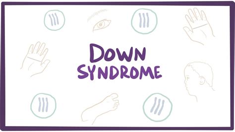 Down syndrome (trisomy 21) - causes, symptoms, diagnosis, & pathology ...