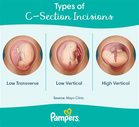 Cesarean Section Anatomy