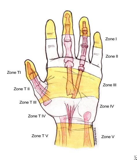 Flexor Tendon Zones Forearm