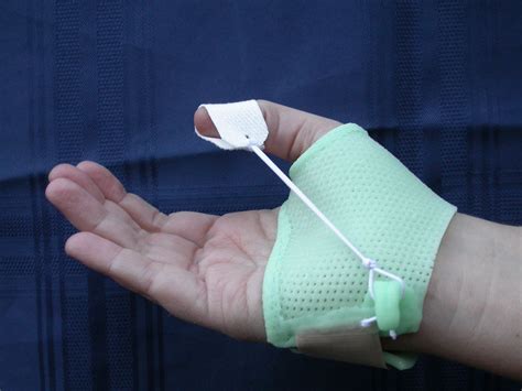 Dynamic Thumb splint made of Turbocast www.ptsonline.com | Hand therapy ...