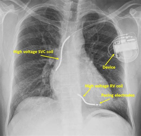 What is an implantable cardioverter defibrillator (ICD)? - All About ...