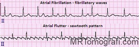 Atrial Fibrilasyon EKG - Nedir, Özellikleri ve Bulguları