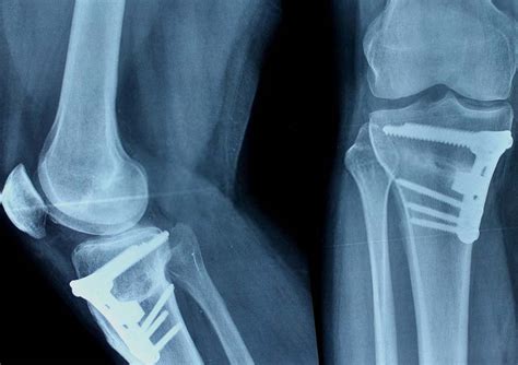 Knee Preservation - Osteotomy Surgery Mumbai | Dr. Jay Shah