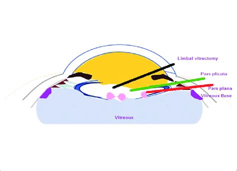 The picture demonstrates the anatomical sites of limbal, pars plicata ...