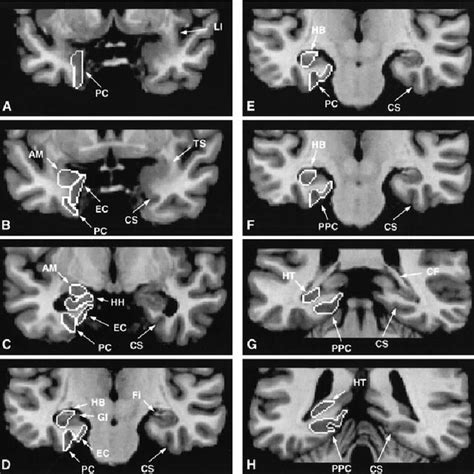 (PDF) Mesial temporal damage in temporal lobe epilepsy: A volumetric ...