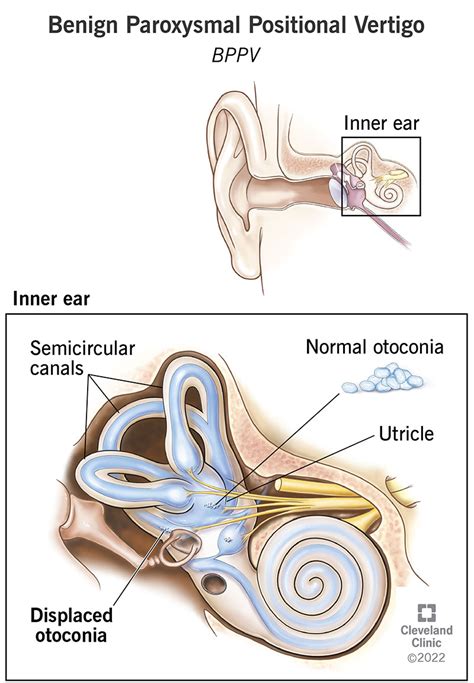 Benign Paroxysmal Positional Vertigo (BPPV): Treatment, Symptoms & Causes