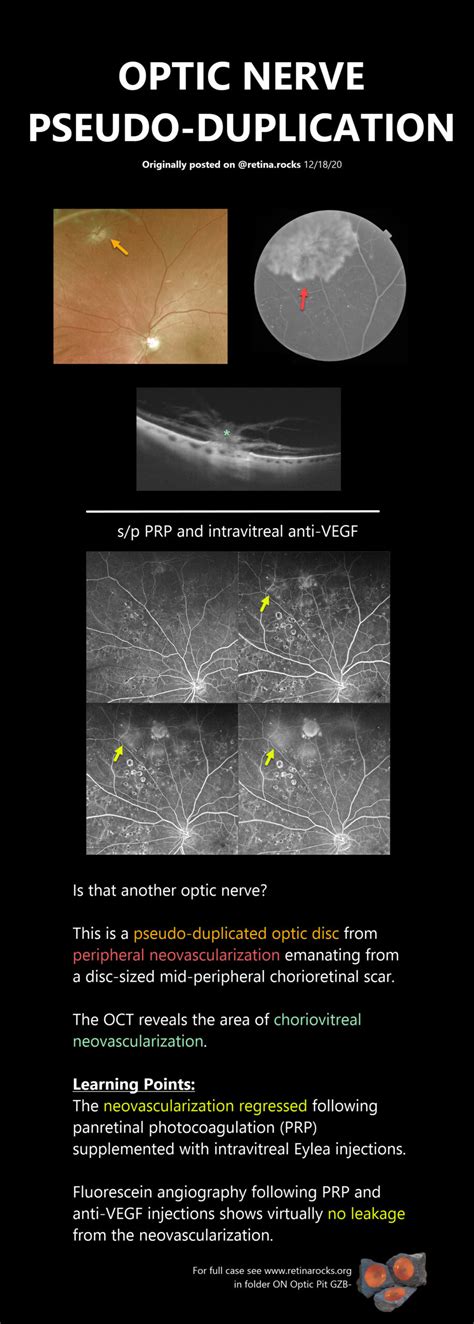 Optic Nerve Disorders > Optic Nerve Pseudo-Duplication - Retina Rocks