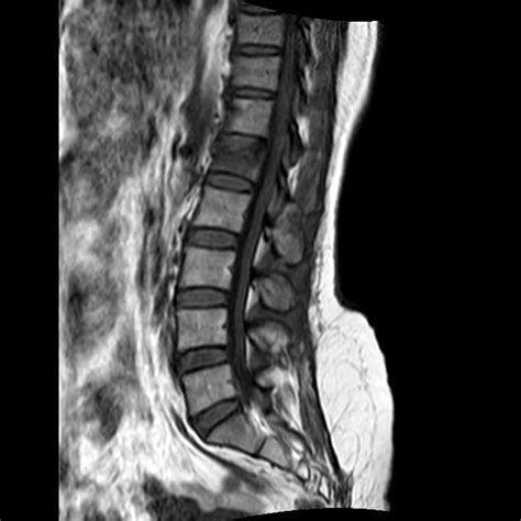 L1 Compression Fracture - Figgymcfatty