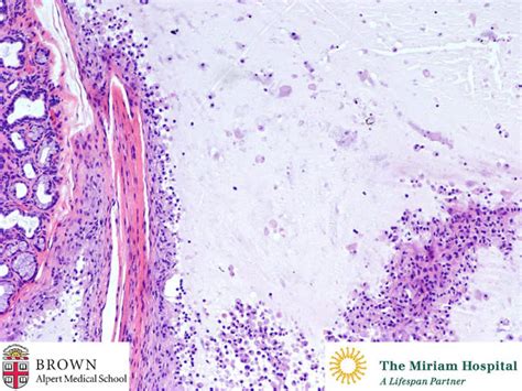 mucocele pathology