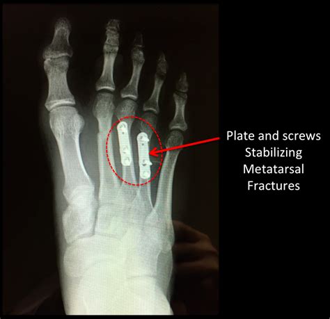 Broken Foot Metatarsal Fracture