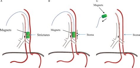 Expert consensus on treating esophageal stenosis in children ...