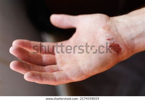 348 Abraded Skin Images, Stock Photos & Vectors | Shutterstock