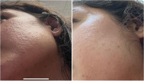 Paula’s choice bha 2% before and after (2months) : r/Skincare_Addiction