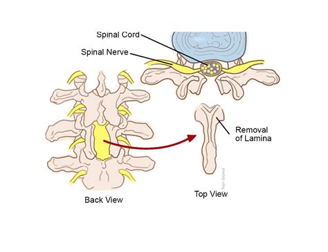 Lumbar Decompression (Laminectomy) - Rajiv Bajekal