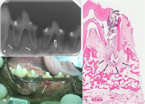 Periapical Abscess Histology