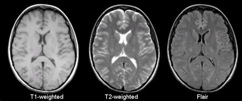 뇌 영상 MRI(Brain MRI) : 네이버 블로그