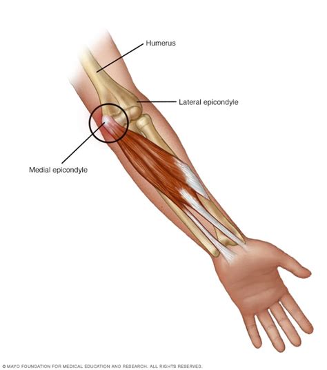 Codo de golfista - Síntomas y causas - Mayo Clinic