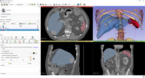 3D Slicer image computing platform | 3D Slicer