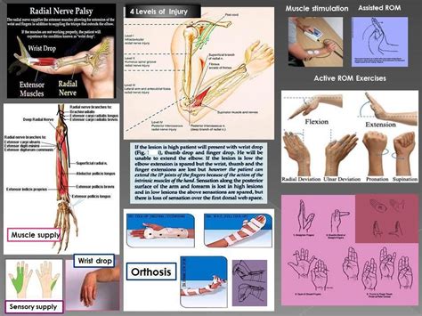 radial nerve palsy exercise | Nerve palsy, Radial nerve, Ulnar nerve