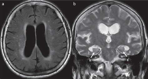 Ventricles Of The Brain Mri